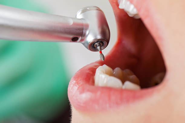 Best Emergency Wisdom Tooth Extraction in Dunbar, WV